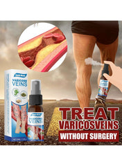 South Moon Varicose Spray: Erase Spider Veins & Stop Leg Pain Instantly